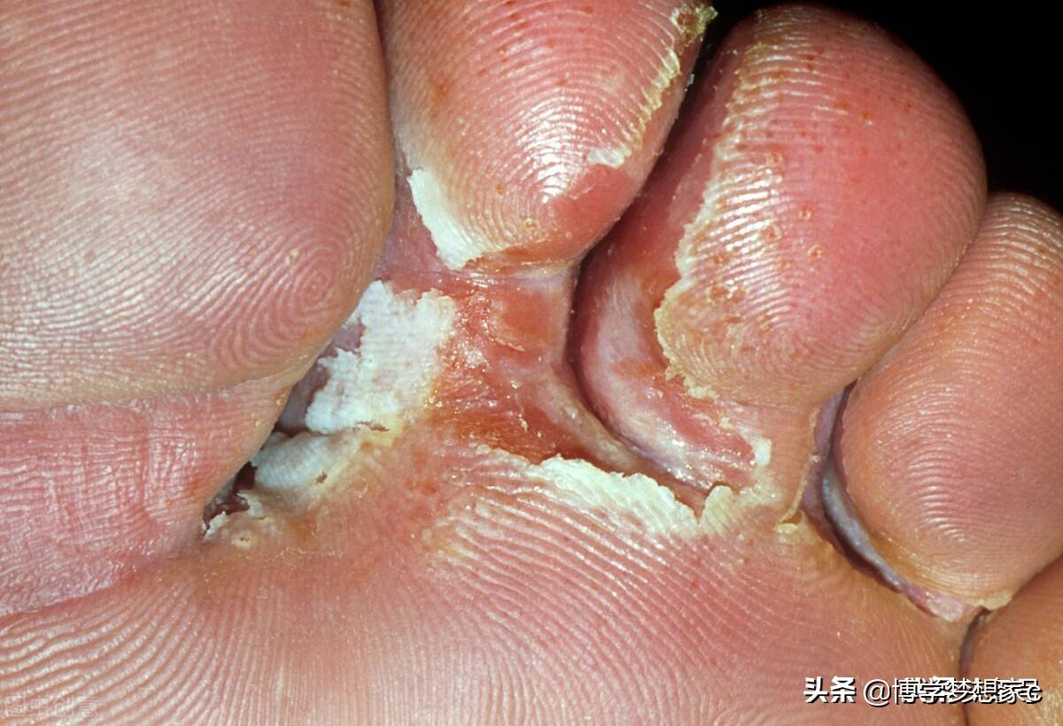 若何医治脚气真菌传染(医治脚癣的真菌殊效药)