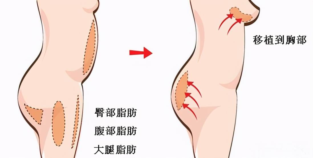 若何能丰胸(自体脂肪丰胸多久能够摸)