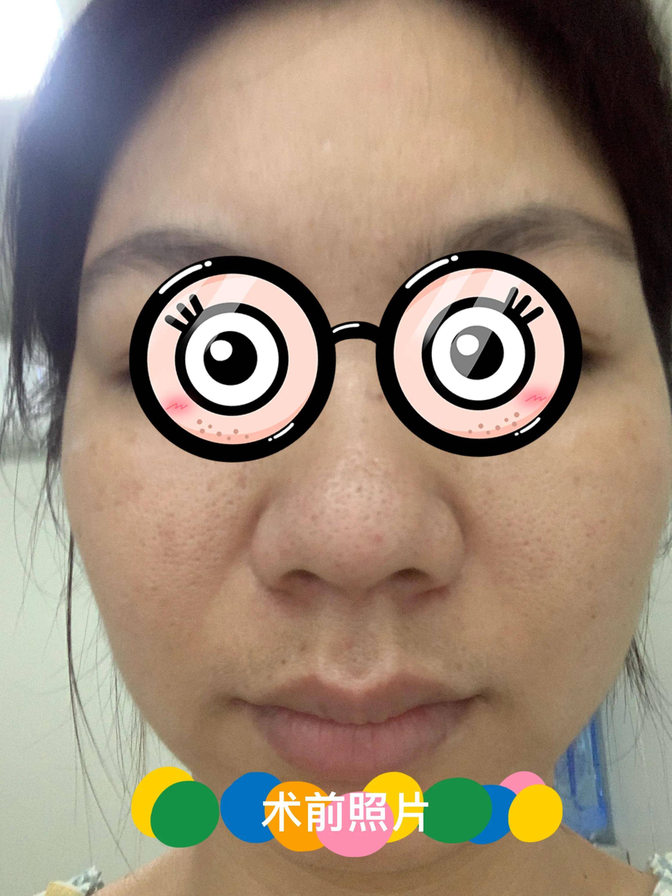 激光去痘坑成果若何(激光去痘坑切身材验)