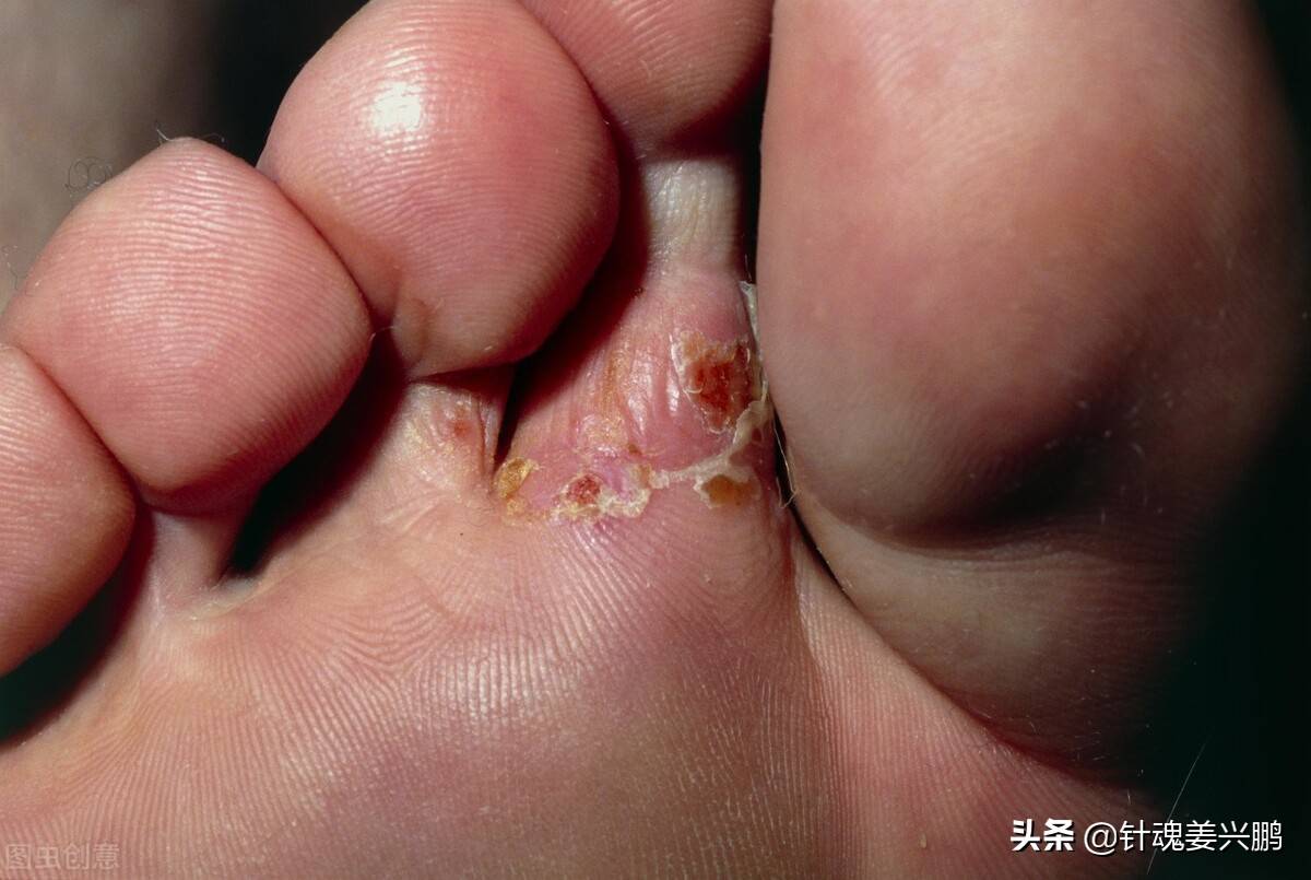 真菌怎样杀死(鞋子里的脚气真菌怎样杀死)