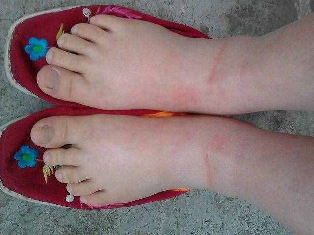 妊妇脚肿是甚么缘由（孕妈双脚浮肿怎样办）