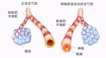 上呼吸道传染多久能好(怎样判定是支气管炎仍是哮喘)