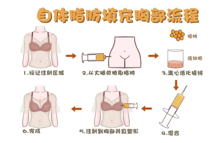 自体脂肪添补保持多久(自体脂肪隆胸是毕生吗)