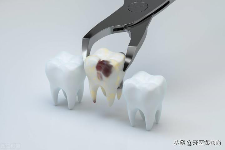 拔牙后多久规复(拔牙后几天能力规复普通)
