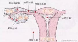 宫外孕手术住院多久(宫外孕吃药杀胚须要住院几天)
