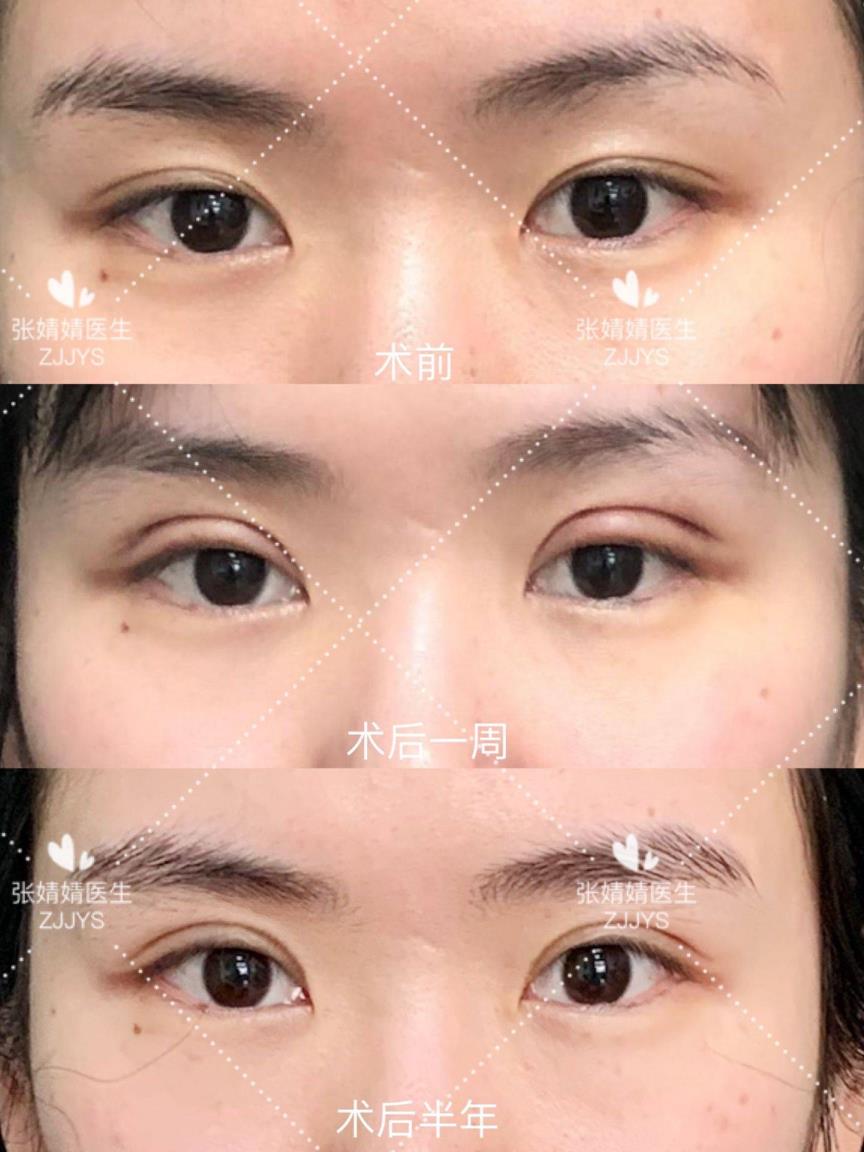割双眼帘多久消肿(割双眼帘甚么季候做比拟好)