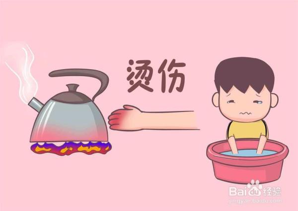 开水烫伤如何办妥得快