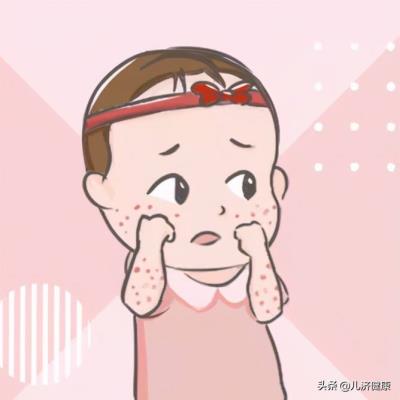 为甚么会长皮疹(过敏皮疹多久能减退)