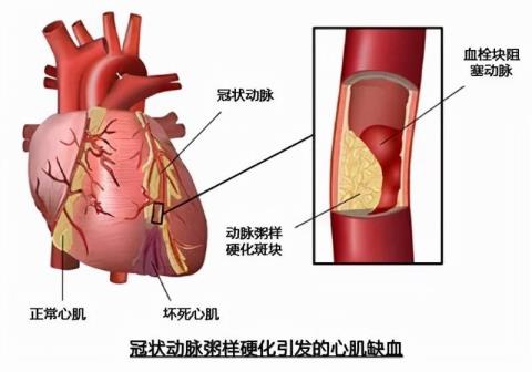 甚么是冠芥蒂(做完心脏造影悔怨死了)